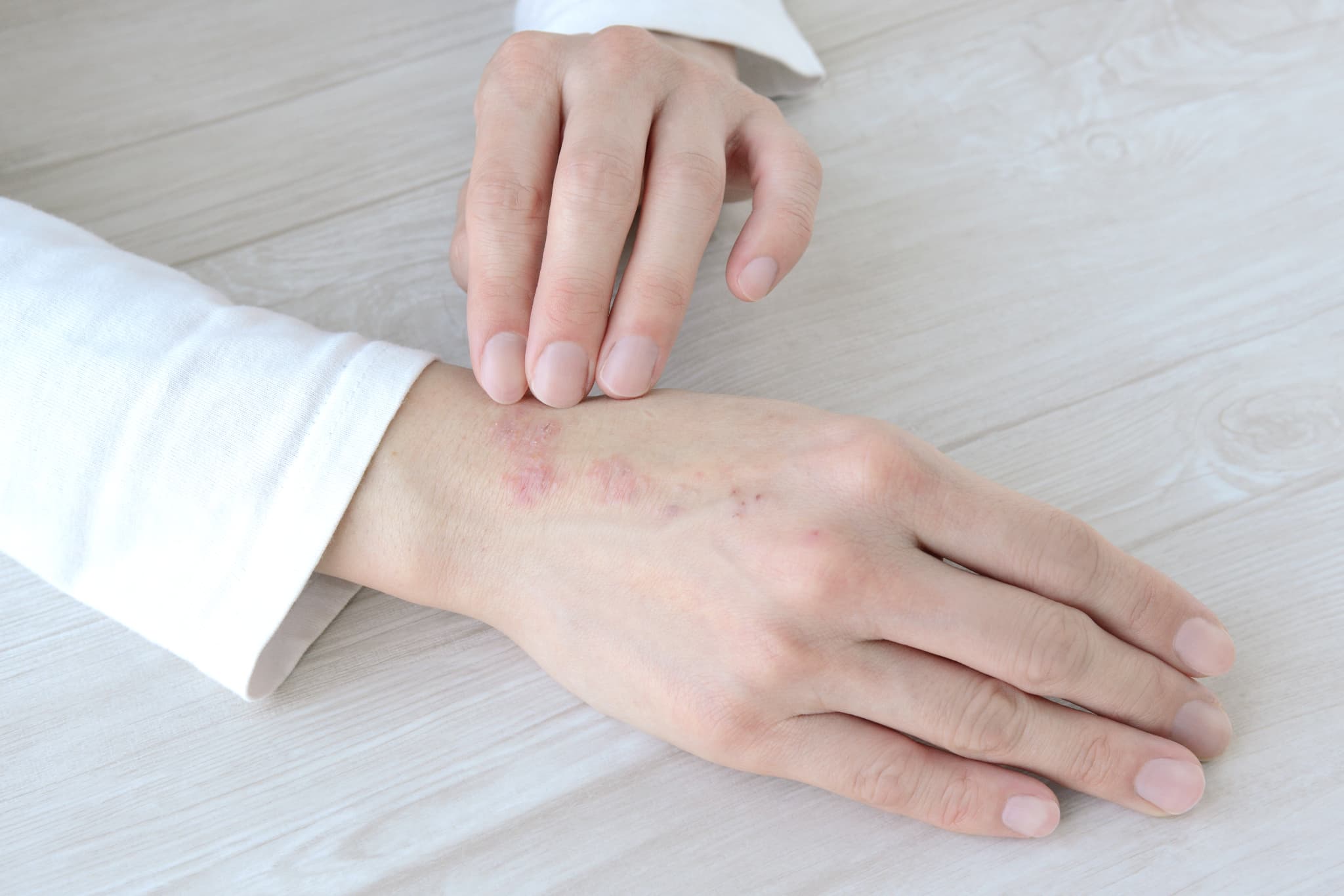 手湿疹