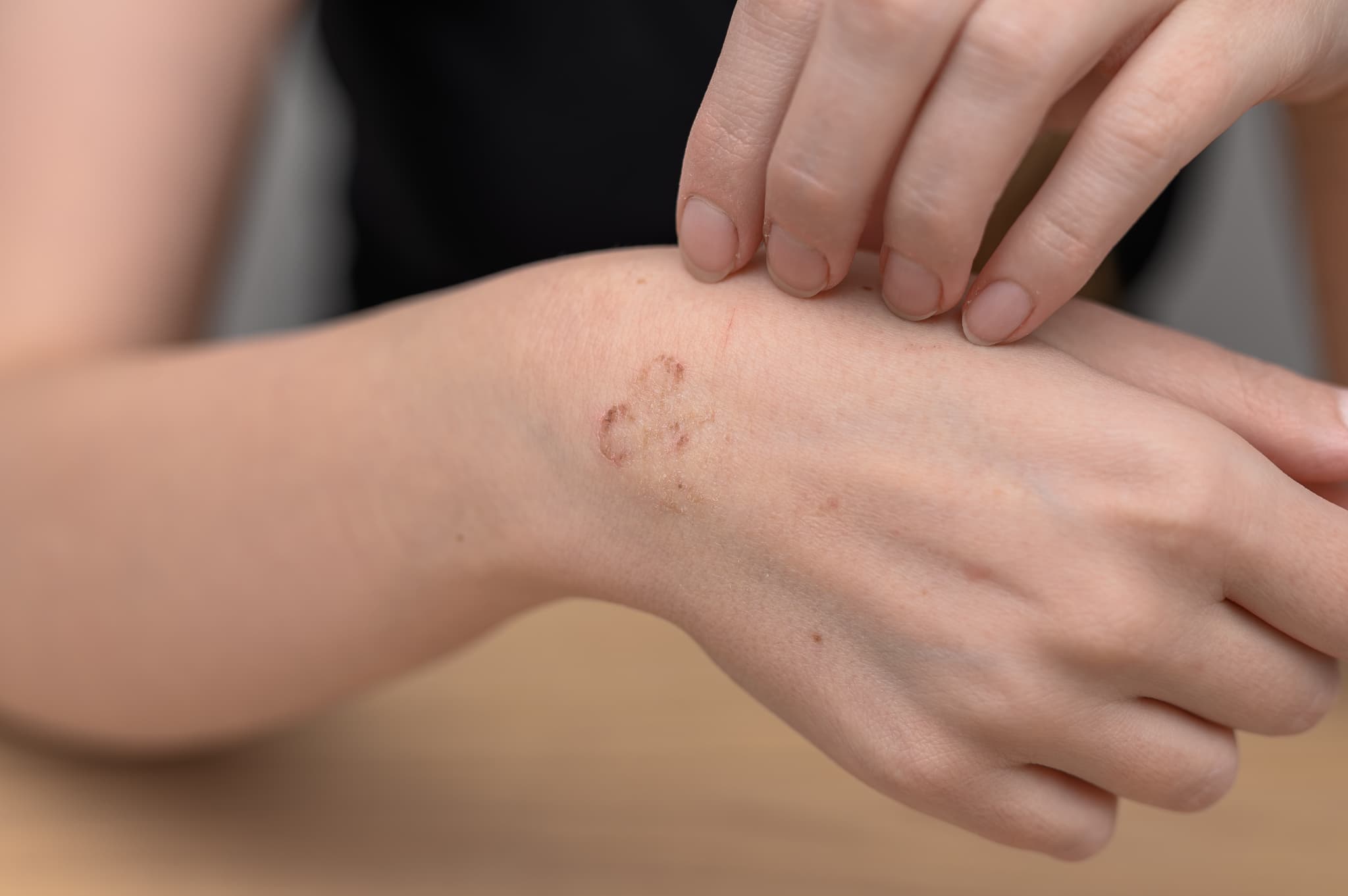 かぶれ（接触皮膚炎）