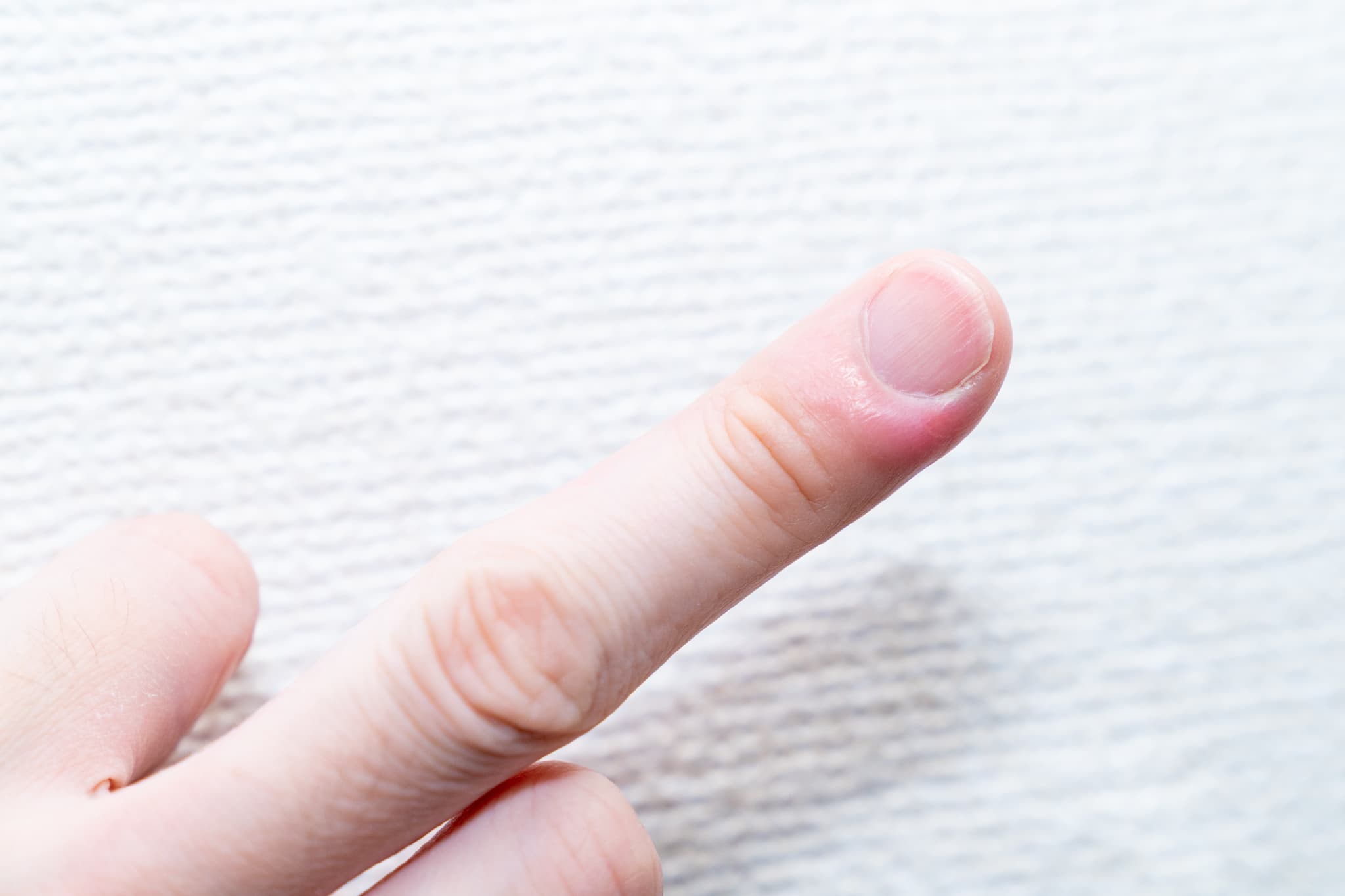 ひょうそ(ひょう疽)・細菌性爪囲炎