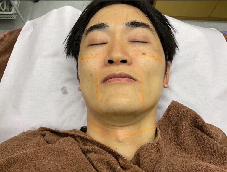 ⑤照射範囲をマーキング