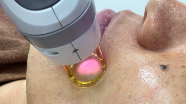 ⑦レーザー照射