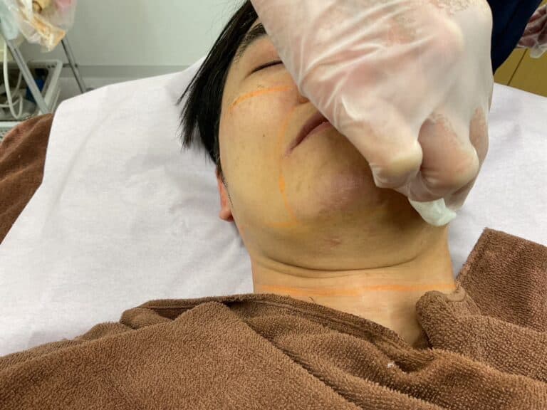 ⑧マーキングを拭き取り