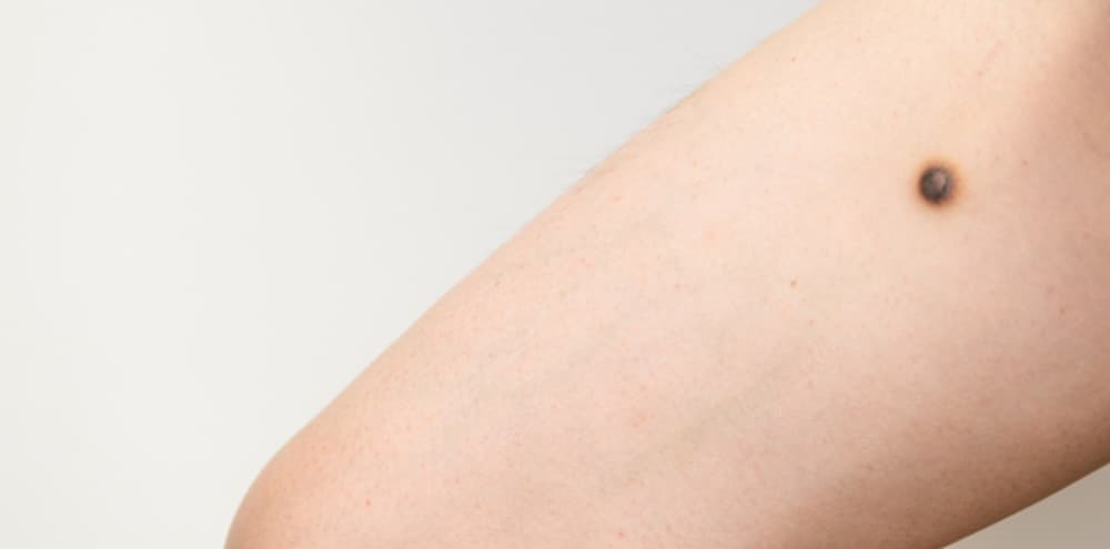 ほくろ、いぼ<br/>＊保険適用の治療もあります