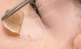 STEP 4｜治療後：テープを剥がすと明るく滑らかな肌に