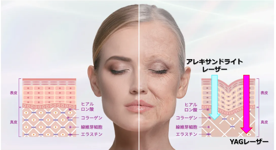 シミやたるみに効果的なアレキサンドライトレーザーとYAGレーザーの違いを示す肌断面図と効果比較イメージ。若々しい肌と老化肌を左右で対比。