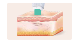 リポットレーザーによるシミ治療中の工程｜ナノ秒レーザーが健康な皮膚を傷つけず色素だけを破壊する安全な施術の図解