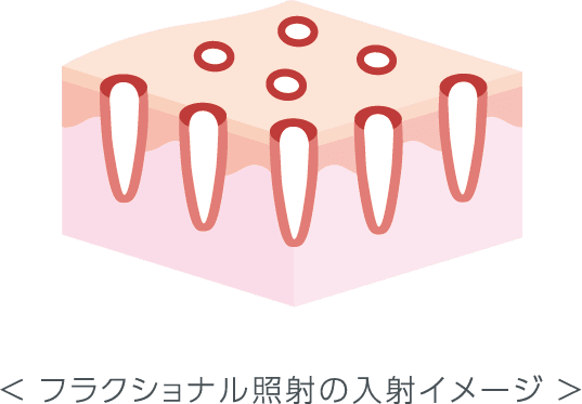 フラクショナルCO2レーザーとは